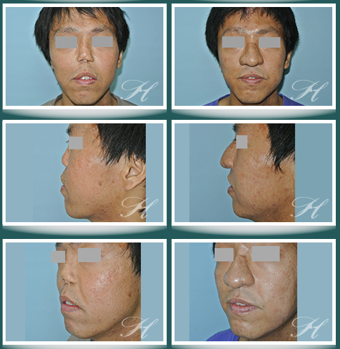 全鼻重建手術-(Total nasal reconstruction) @ 長庚蕭彥彰主任的專業